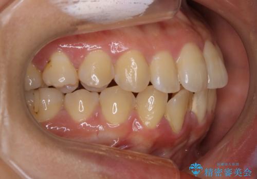 前歯を後ろに下げたい ワイヤー矯正(クリア装置)の治療前