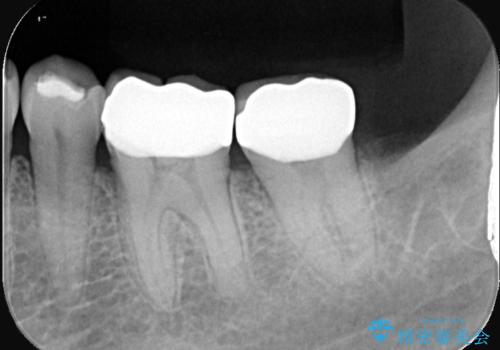 割れた奥歯をセラミックで修復の治療後