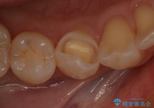 虫歯のところをセラミックで直したい　セラミックインレーの治療中