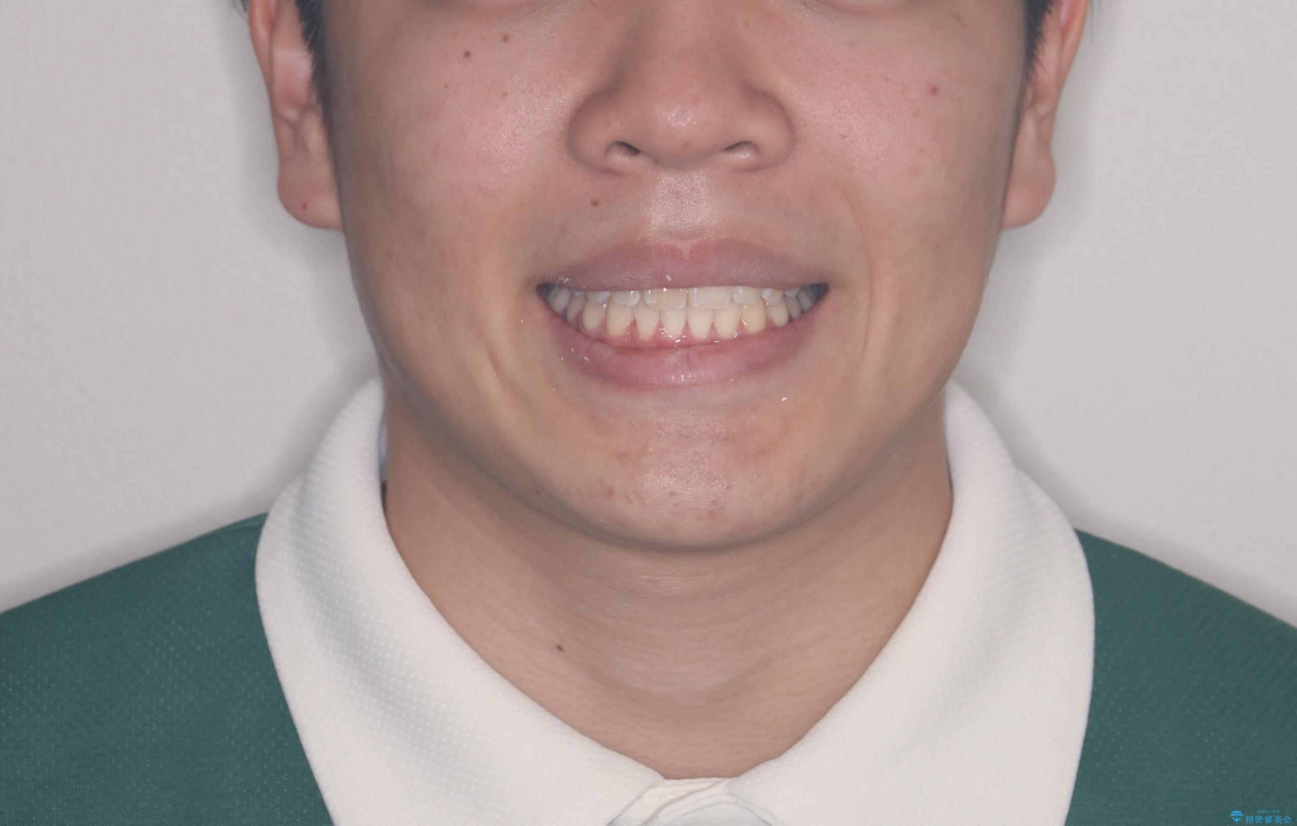 【ワイヤー矯正】前歯が出ているのが気になるの治療後(顔貌)