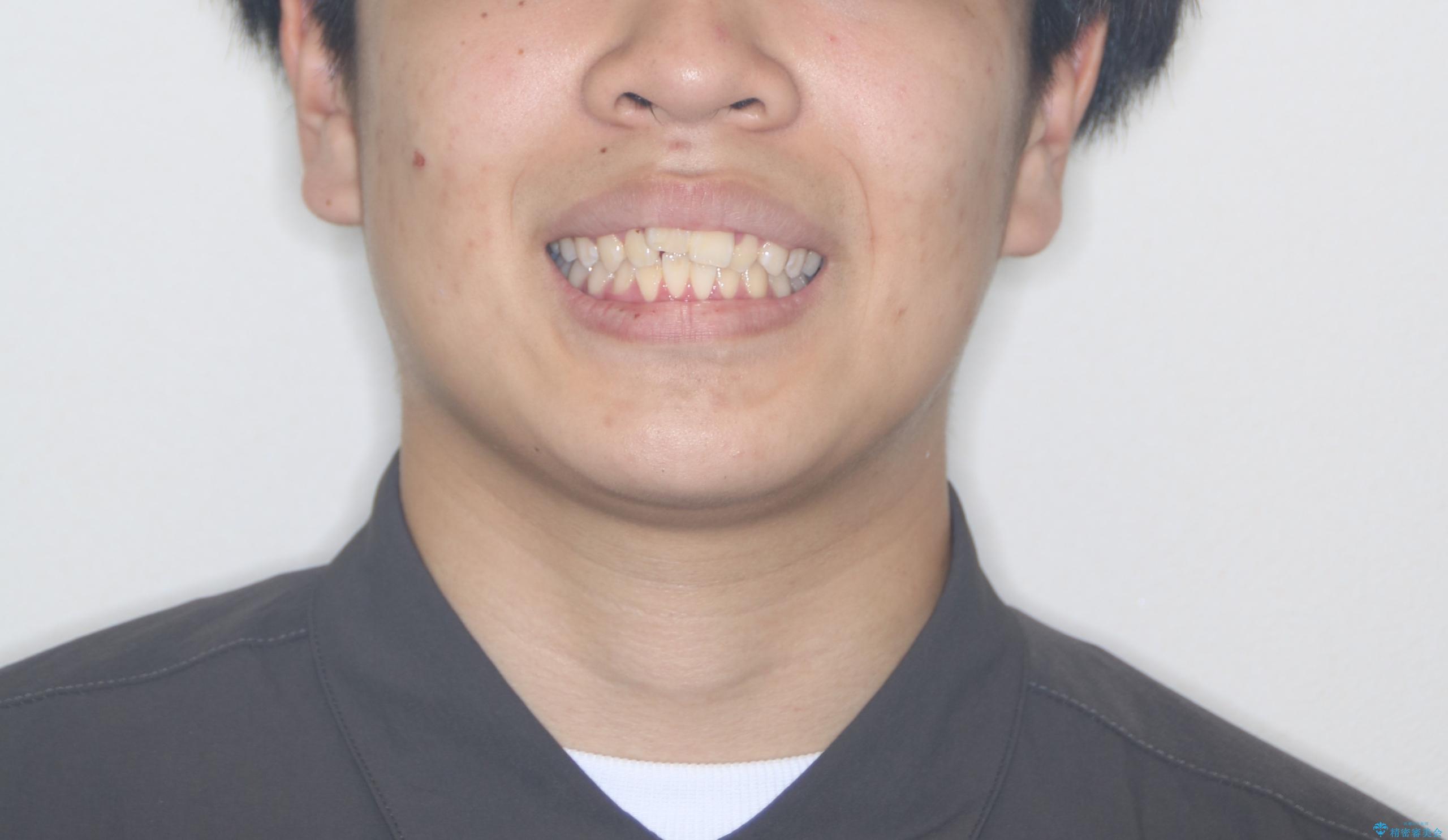 【ワイヤー矯正】前歯が出ているのが気になるの治療前(顔貌)