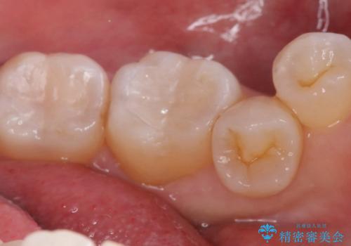 【セラミックインレー】口の中の銀の詰め物を白い物に替えたいの治療後