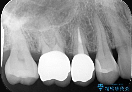 古い被せ物の中のむし歯を治療の治療後