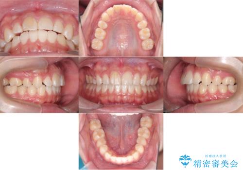 【ワイヤー矯正】前歯が出ているのが気になるの治療後