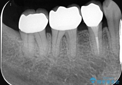 目立つ銀歯を白く自然な歯に改善の治療後