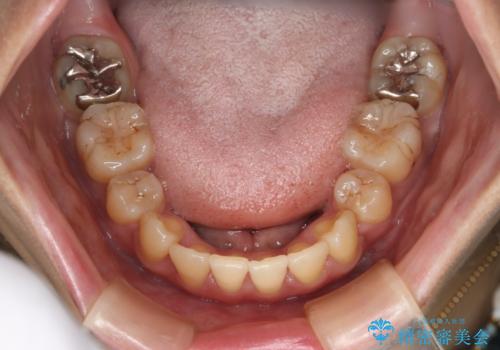 前歯を後ろに下げたい ワイヤー矯正(クリア装置)の治療後