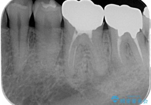 銀歯・虫歯・治療途中の歯を治していきたいの治療前