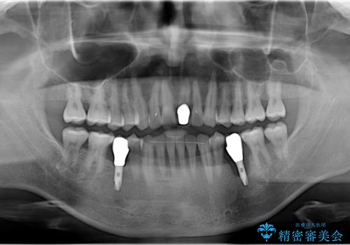 20年前にいれたインプラント|インプラント周囲炎|古いインプラントを除去しインプラント再埋入|痛く無いインプラント治療の治療前