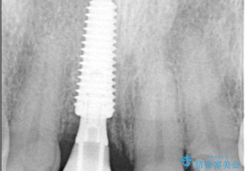 折れた前歯を即時インプラントで回復の治療中