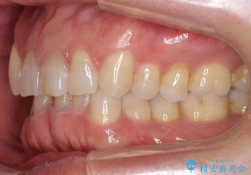 八重歯と下の歯のがたつき マウスピースでの治療前
