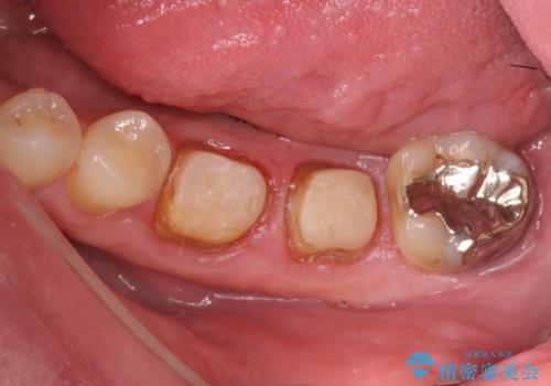 銀歯・虫歯・治療途中の歯を治していきたいの治療中