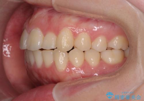 前歯のズレ・がたつき・すれ違いの矯正治療の治療後