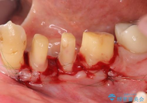 歯周病再生治療と歯周ポケット除去 歯周外科手術の治療中