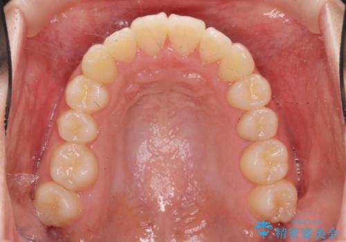 前歯のズレ・がたつき・すれ違いの矯正治療の治療後