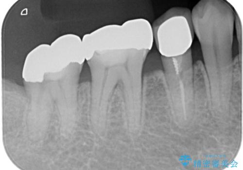 目立つ銀歯を白く自然な歯に改善の治療前