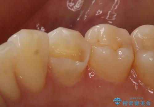 虫歯のところをセラミックで直したい セラミックインレーの治療中