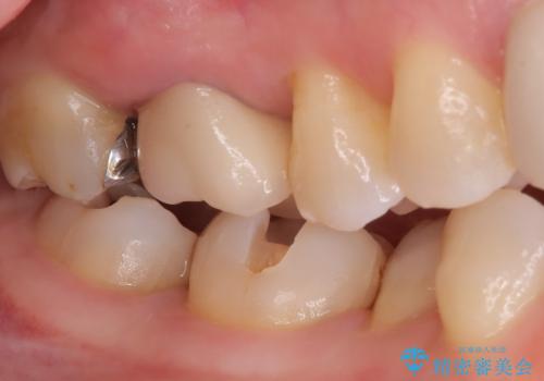 【セラミックインレー】口の中の銀の詰め物を白い物に替えたいの治療中