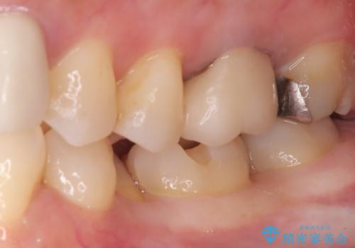 【セラミックインレー】口の中の銀の詰め物を白い物に替えたいの治療中