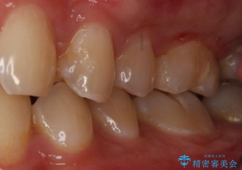 銀歯をやり変えたい セラミックインレーの治療後