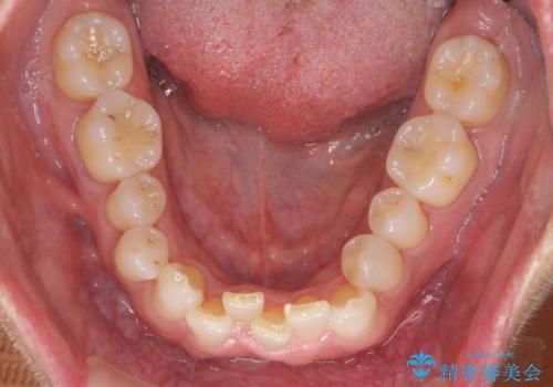 八重歯と下の歯のがたつき マウスピースでの治療前