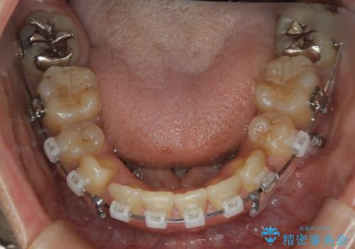 前歯を後ろに下げたい ワイヤー矯正(クリア装置)の治療中