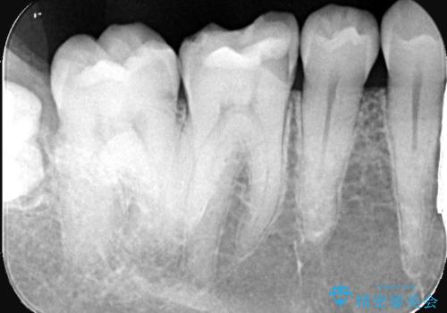 歯が欠けた <セラミッククラウン>の治療前