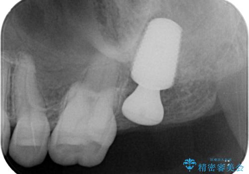 治療途中の虫歯の歯をインプラントにしたい インプラント治療の治療中