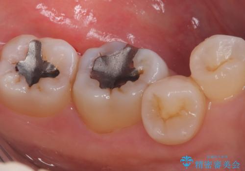 【セラミックインレー】口の中の銀の詰め物を白い物に替えたいの治療前