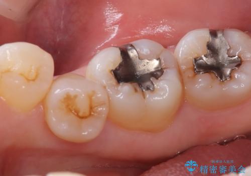 【セラミックインレー】口の中の銀の詰め物を白い物に替えたいの治療前