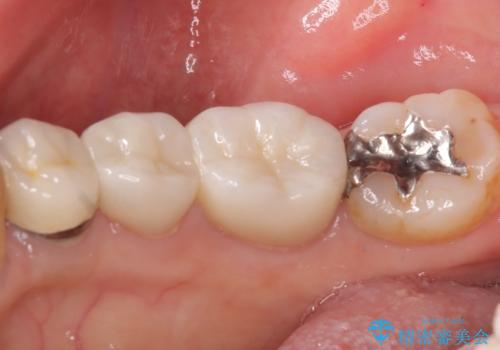 【セラミックインレー】笑うと銀の詰め物が目立つの治療前