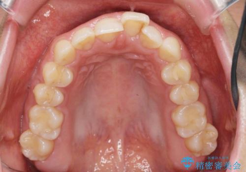 出っ歯に見える前歯の改善 部分ワイヤーとマウスピース矯正の治療前