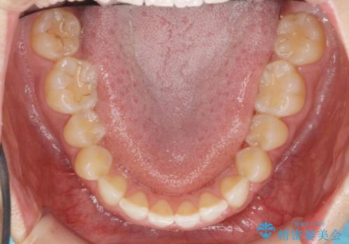 出っ歯に見える前歯の改善 部分ワイヤーとマウスピース矯正の治療前