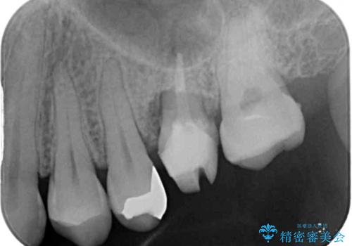 割れてしまった奥歯 インプラント治療の治療前
