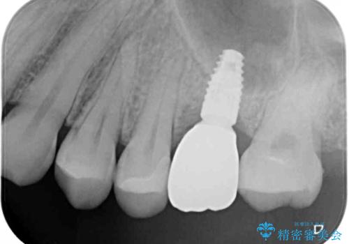 割れてしまった奥歯 インプラント治療の治療後