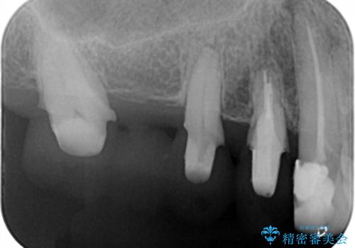 ツギハギの被せ物をキレイなセラミックへの治療中