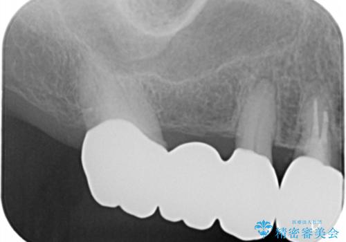 ツギハギの被せ物をキレイなセラミックへの治療後