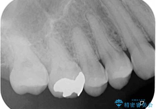 割れてしまった奥歯 インプラント治療の治療前
