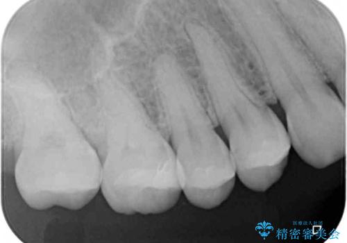 割れてしまった奥歯 インプラント治療の治療後