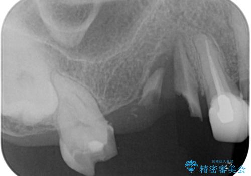 奥歯で噛みたい 破折した歯のインプラント治療の治療前