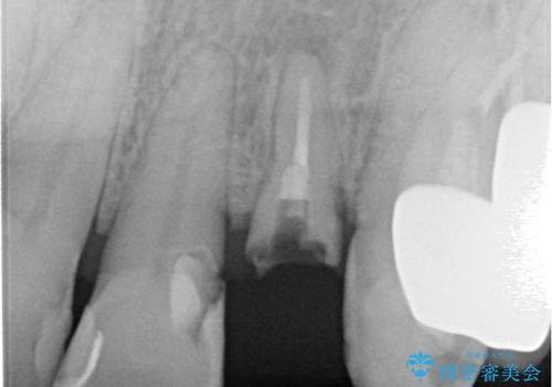 破折した前歯のインプラント 1DAYインプラントで短期間治療の治療前
