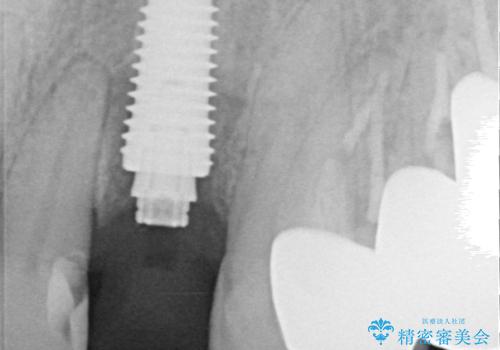 破折した前歯のインプラント 1DAYインプラントで短期間治療の治療中