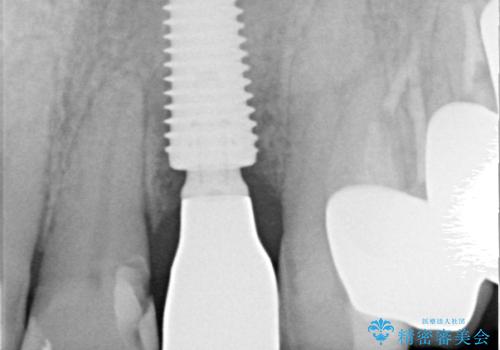 破折した前歯のインプラント 1DAYインプラントで短期間治療の治療後