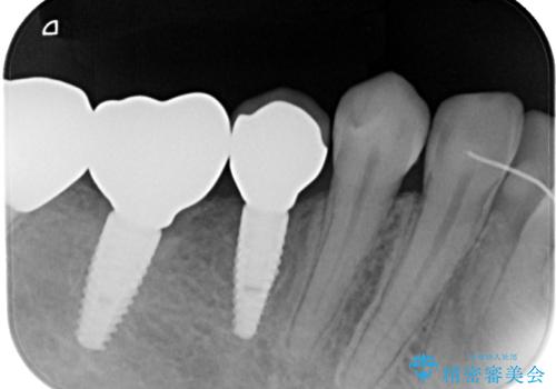 割れてしまった奥歯 インプラント治療の治療後