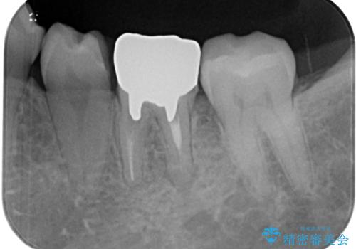 割れてしまった奥歯 インプラント治療の治療前