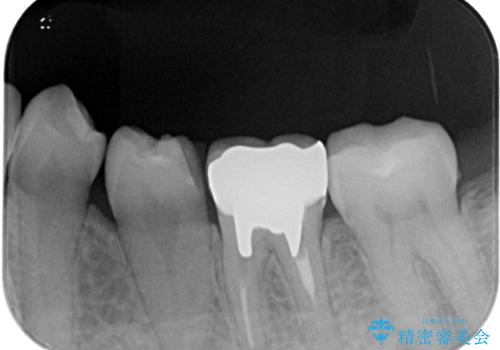 割れてしまった奥歯 インプラント治療の治療後