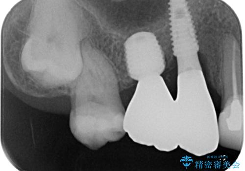 奥歯で噛みたい 破折した歯のインプラント治療の治療後