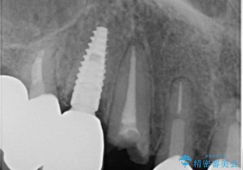ニューヨークから1泊で通院 1DAYインプラントの治療前
