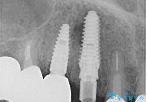 ニューヨークから1泊で通院 1DAYインプラントの治療中
