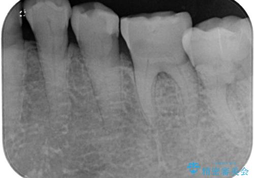 奥歯がたまにしみる フルジルコニアクラウンの補綴治療の治療前