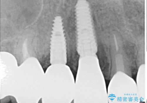 ニューヨークから1泊で通院 1DAYインプラントの治療後